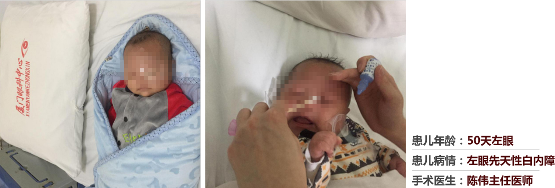 患兒年齡：50天左眼，患兒病情：左眼先天性白內(nèi)障，手術(shù)醫(yī)生：白內(nèi)障科陳偉主任醫(yī)師