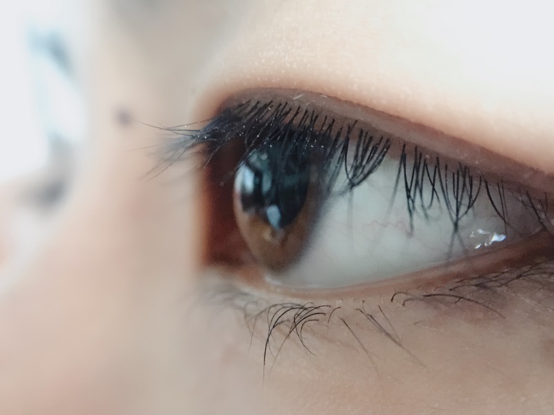 上眼皮為什么會(huì)下垂？上瞼下垂是怎么引起的？