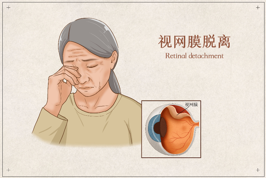 視網膜脫落的癥狀