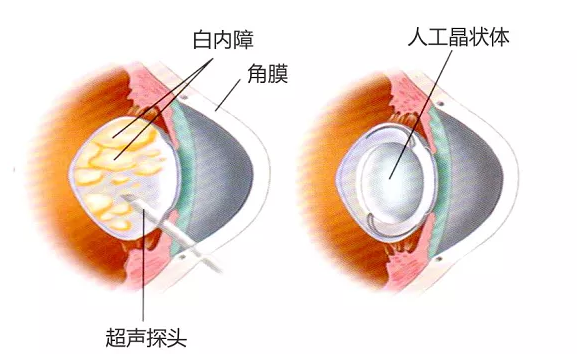 先天性白內(nèi)障
