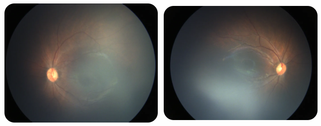 早產兒視網膜病變