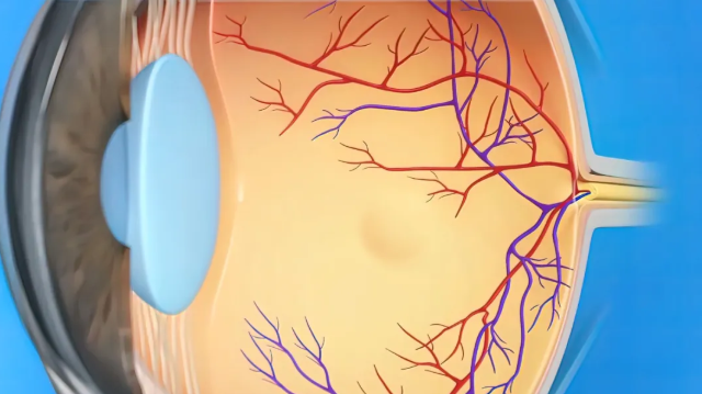 糖尿病視網(wǎng)膜病變
